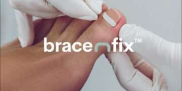 BracenFix™: A Revolutionary Solution for Ingrown and Involuted Toenails Without Surgery